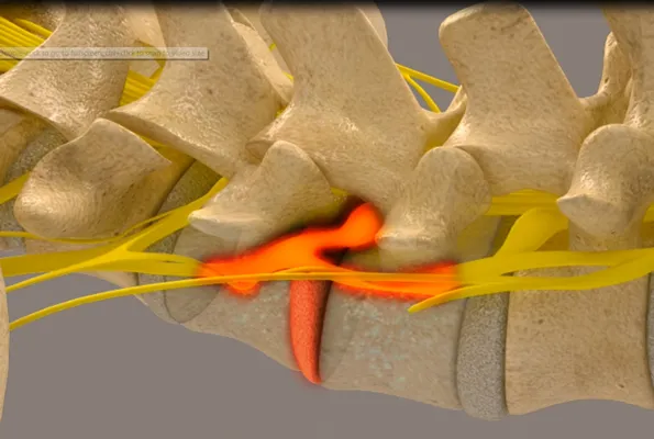 Chiropractic Chapin SC Decompression Phase 1