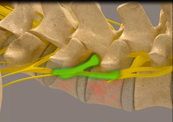 Chiropractic Chapin SC Decompression Phase 3