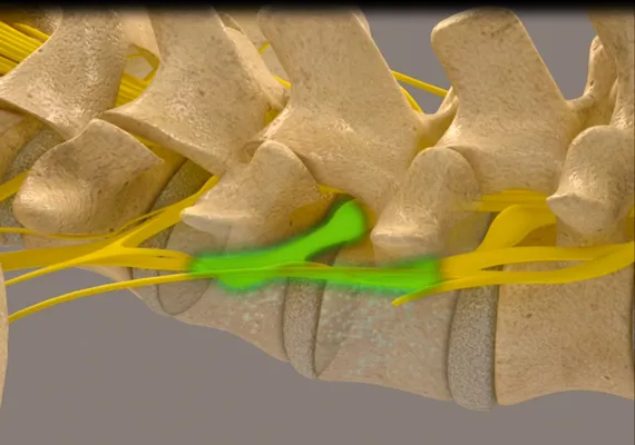 Chiropractic Chapin SC Decompression Phase 4